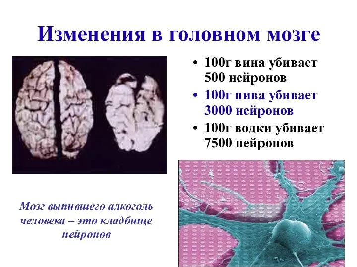 Изменения в головном мозге 100г вина убивает 500 нейронов 100г пива