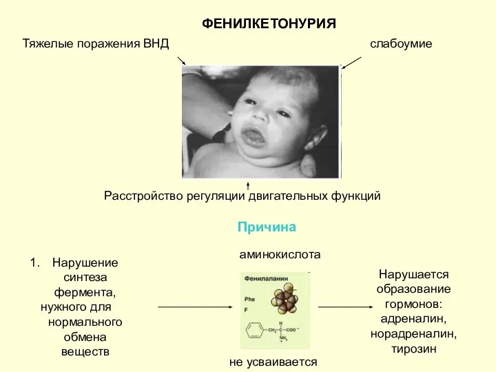 ФЕНИЛКЕТОНУРИЯ Тяжелые поражения ВНД слабоумие Расстройство регуляции двигательных функций Причина Нарушение