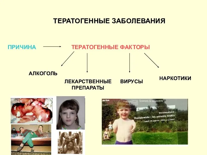 ТЕРАТОГЕННЫЕ ЗАБОЛЕВАНИЯ ПРИЧИНА ТЕРАТОГЕННЫЕ ФАКТОРЫ АЛКОГОЛЬ ЛЕКАРСТВЕННЫЕ ПРЕПАРАТЫ ВИРУСЫ НАРКОТИКИ