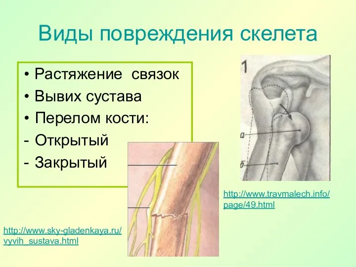 Виды повреждения скелета Растяжение связок Вывих сустава Перелом кости: Открытый Закрытый http://www.travmalech.info/page/49.html http://www.sky-gladenkaya.ru/vyvih_sustava.html