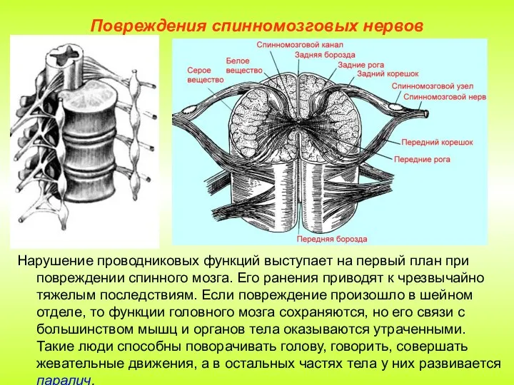 Повреждения спинномозговых нервов Нарушение проводниковых функций выступает на первый план при