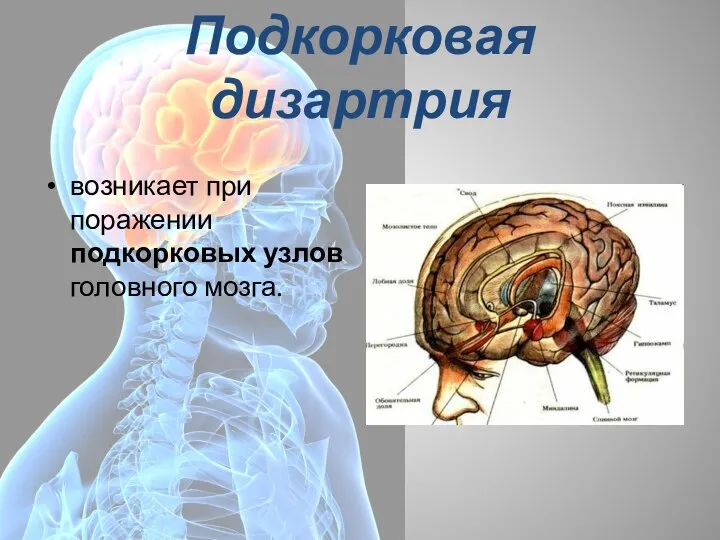 Подкорковая дизартрия возникает при поражении подкорковых узлов головного мозга.