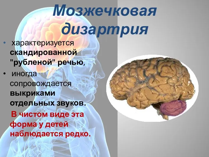 Мозжечковая дизартрия характеризуется скандированной "рубленой" речью, иногда сопровождается выкриками отдельных звуков.