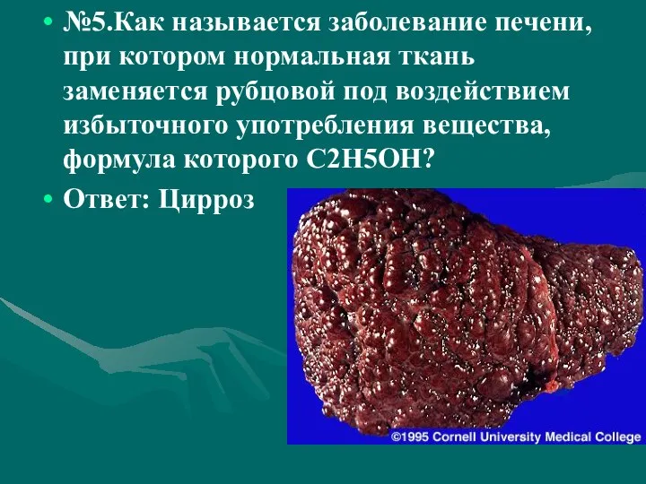 №5.Как называется заболевание печени, при котором нормальная ткань заменяется рубцовой под