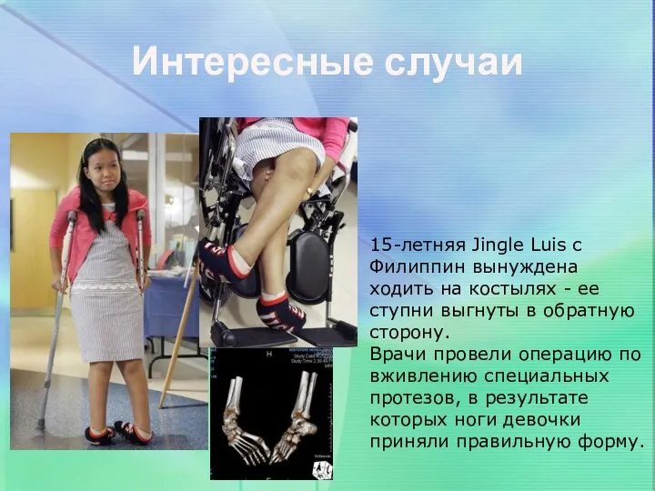 Интересные случаи 15-летняя Jingle Luis с Филиппин вынуждена ходить на костылях