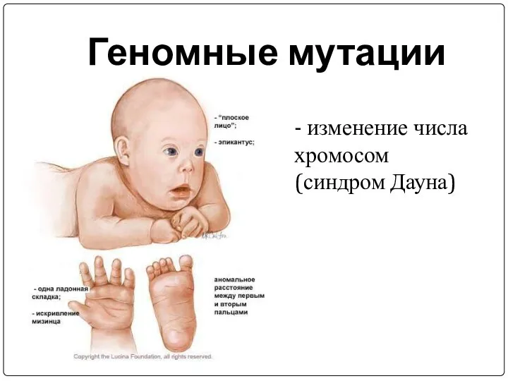 Геномные мутации - изменение числа хромосом (синдром Дауна)