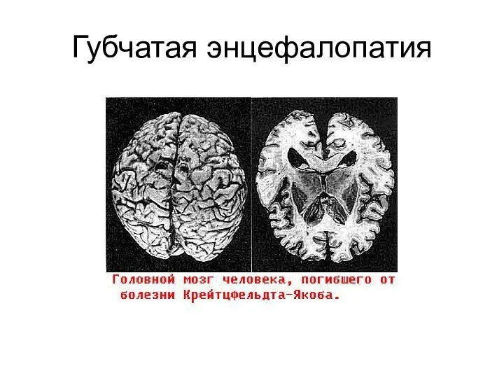 Губчатая энцефалопатия