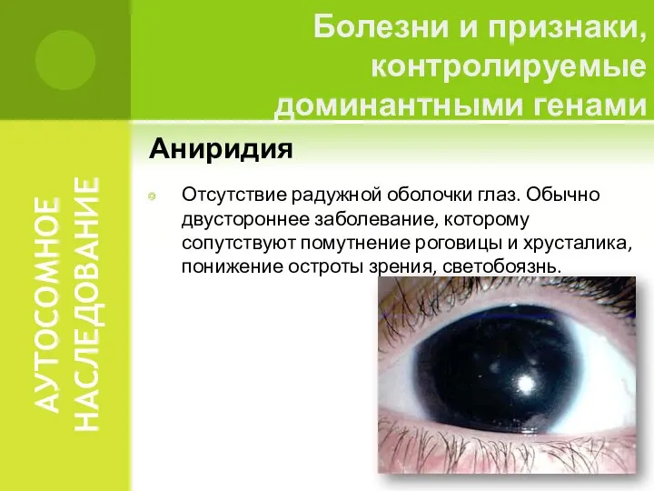 АУТОСОМНОЕ НАСЛЕДОВАНИЕ Аниридия Отсутствие радужной оболочки глаз. Обычно двустороннее заболевание, которому
