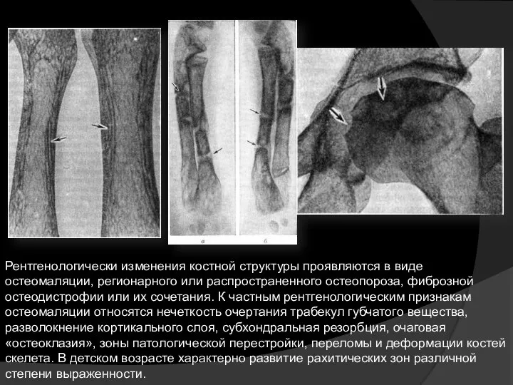 Рентгенологически изменения костной структуры проявляются в виде остеомаляции, регионарного или распространенного