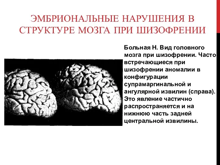 Эмбриональные нарушения в структуре мозга при шизофрении Больная Н. Вид головного