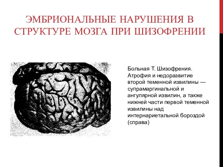 Эмбриональные нарушения в структуре мозга при шизофрении Больная Т. Шизофрения. Атрофия