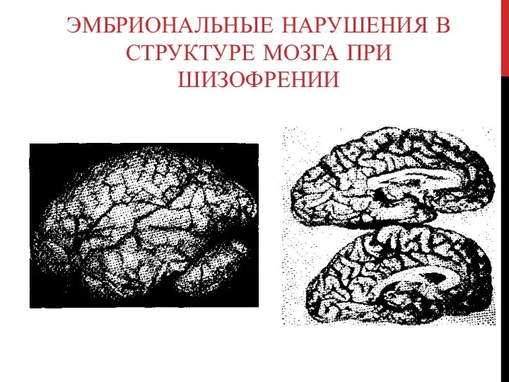 Эмбриональные нарушения в структуре мозга при шизофрении