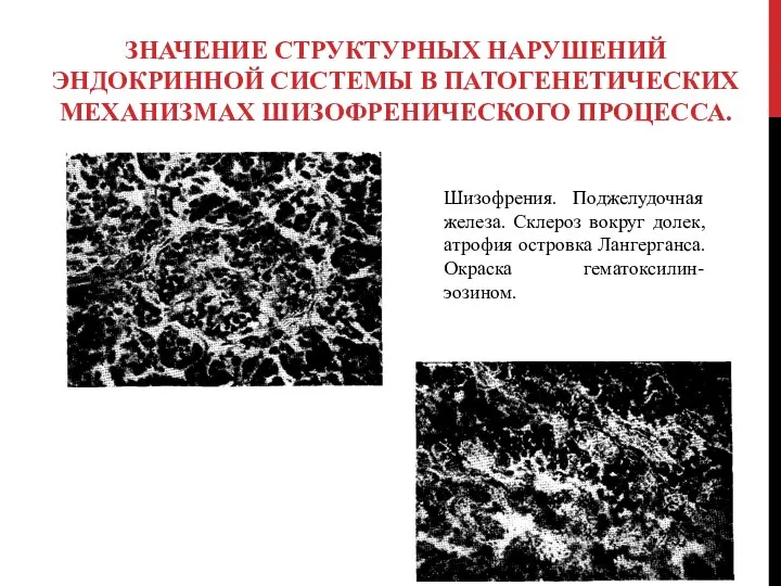 Значение структурных нарушений эндокринной системы в патогенетических механизмах шизофренического процесса. Шизофрения.