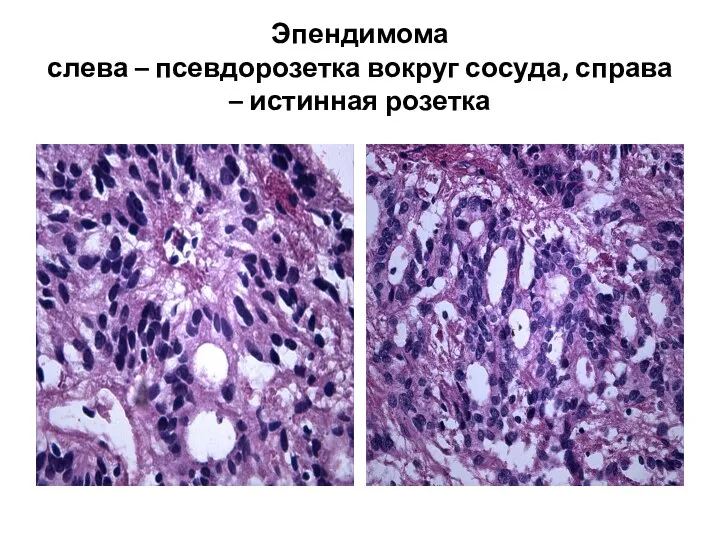 Эпендимома слева – псевдорозетка вокруг сосуда, справа – истинная розетка