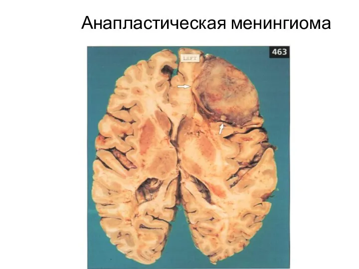 Анапластическая менингиома