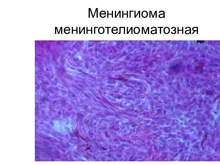 Менингиома менинготелиоматозная