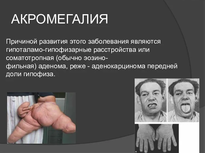 АКРОМЕГАЛИЯ Причиной развития этого заболевания являются гипоталамо-гипофизарные расстройства или соматотропная (обычно