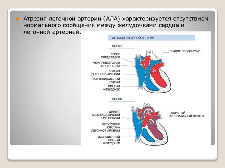 Атрезия легочной артерии (АЛА) характеризуется отсутствием нормального сообщения между желудочками сердца и легочной артерией.