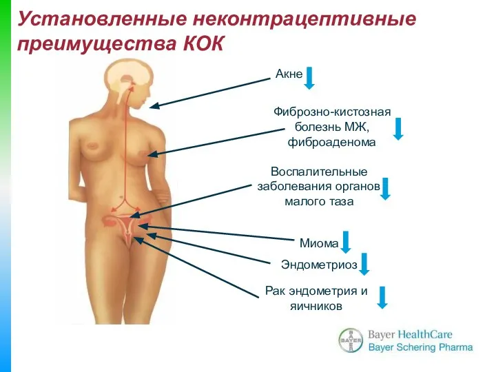 Aкне Фиброзно-кистозная болезнь МЖ, фиброаденома Воспалительные заболевания органов малого таза Миома