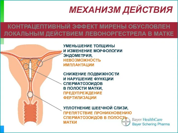 МЕХАНИЗМ ДЕЙСТВИЯ УМЕНЬШЕНИЕ ТОЛЩИНЫ И ИЗМЕНЕНИЕ МОРФОЛОГИИ ЭНДОМЕТРИЯ, НЕВОЗМОЖНОСТЬ ИМПЛАНТАЦИИ СНИЖЕНИЕ