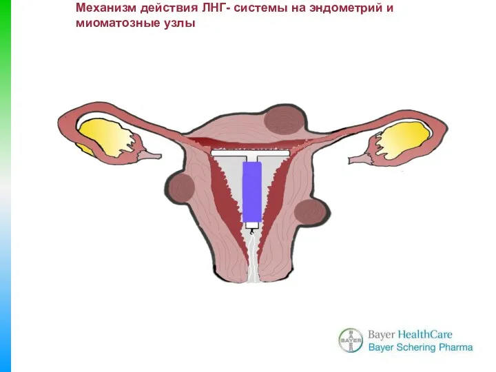 Механизм действия ЛНГ- системы на эндометрий и миоматозные узлы