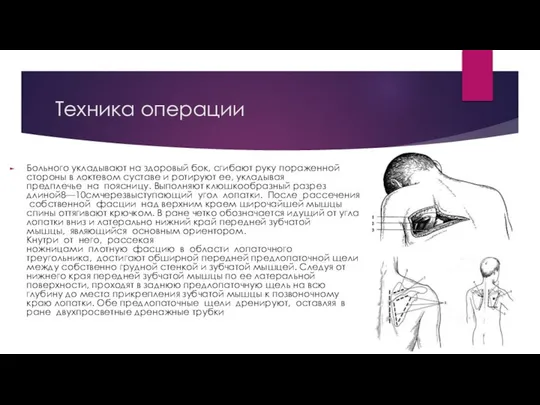 Техника операции Больного укладывают на здоровый бок, сгибают руку пораженной стороны