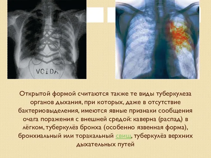 Открытой формой считаются также те виды туберкулеза органов дыхания, при которых,