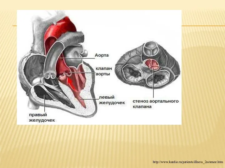 http://www.kardio.ru/patients/illness_2astenoz.htm