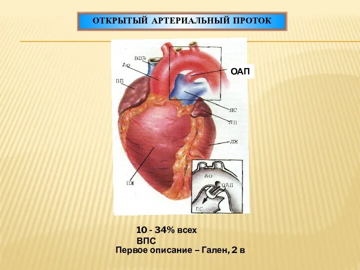 ОТКРЫТЫЙ АРТЕРИАЛЬНЫЙ ПРОТОК ОАП 10 - 34% всех ВПС Первое описание – Гален, 2 в