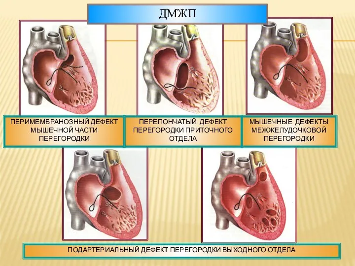 ПОДАРТЕРИАЛЬНЫЙ ДЕФЕКТ ПЕРЕГОРОДКИ ВЫХОДНОГО ОТДЕЛА ПЕРЕПОНЧАТЫЙ ДЕФЕКТ ПЕРЕГОРОДКИ ПРИТОЧНОГО ОТДЕЛА ПЕРИМЕМБРАНОЗНЫЙ