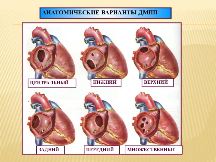 АНАТОМИЧЕСКИЕ ВАРИАНТЫ ДМПП ЦЕНТРАЛЬНЫЙ НИЖНИЙ ВЕРХНИЙ ЗАДНИЙ ПЕРЕДНИЙ МНОЖЕСТВЕННЫЕ