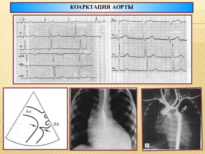 КОАРКТАЦИЯ АОРТЫ