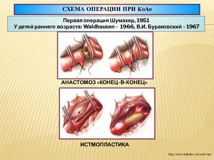 СХЕМА ОПЕРАЦИИ ПРИ КоАо АНАСТОМОЗ «КОНЕЦ-В-КОНЕЦ» ИСТМОПЛАСТИКА Первая операция Шумахер, 1951