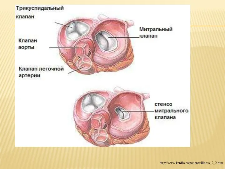 http://www.kardio.ru/patients/illness_2_2.htm