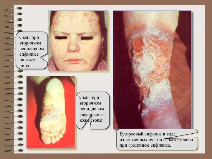 Бугорковый сифилис в виде изъязвленных очагов на коже голени при третичном