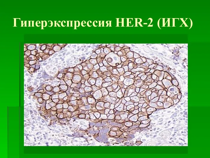 Гиперэкспрессия HER-2 (ИГХ)