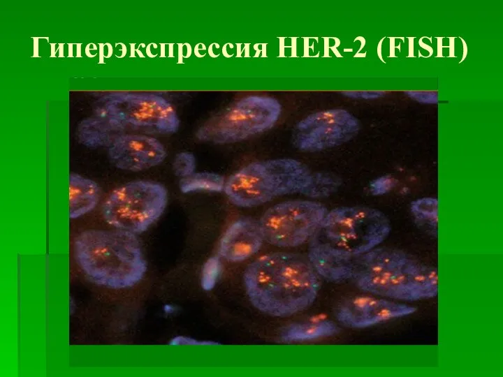 Гиперэкспрессия HER-2 (FISH)