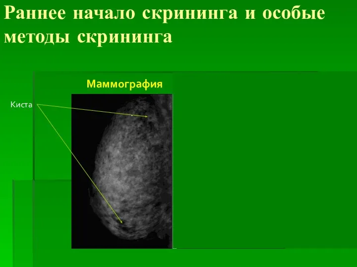 Раннее начало скрининга и особые методы скрининга Маммография МРТ Киста