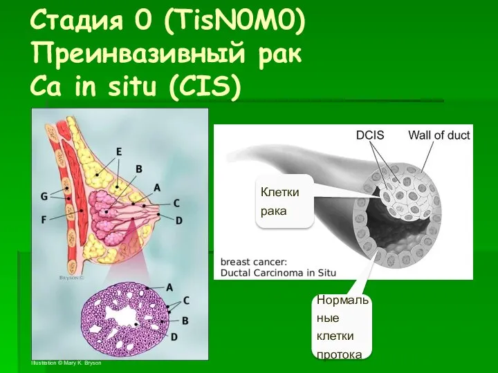 Стадия 0 (TisN0M0) Преинвазивный рак Ca in situ (CIS) Illustration ©