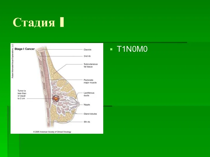 Стадия I T1N0M0