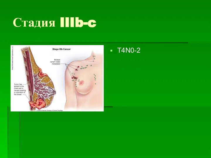Стадия IIIb-c T4N0-2