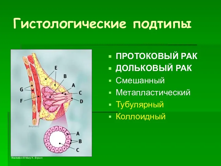 Гистологические подтипы ПРОТОКОВЫЙ РАК ДОЛЬКОВЫЙ РАК Смешанный Метапластический Тубулярный Коллоидный Illustration © Mary K. Bryson