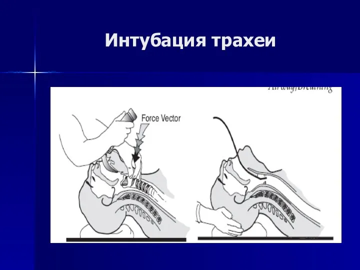 Интубация трахеи