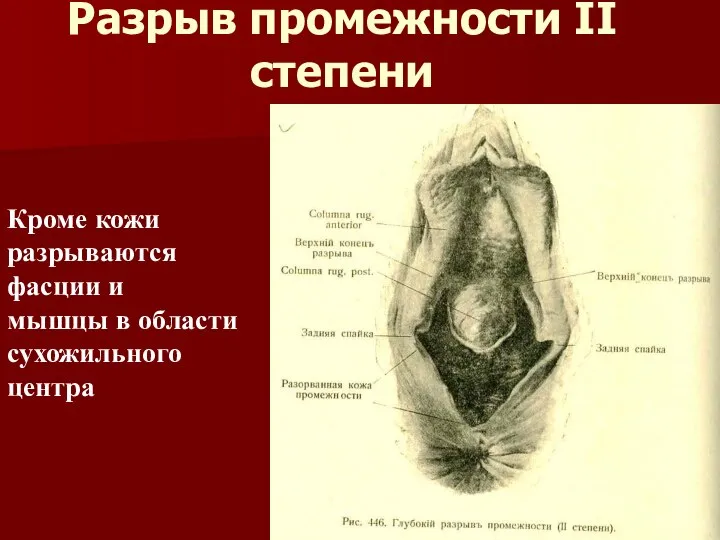 Разрыв промежности II степени Кроме кожи разрываются фасции и мышцы в области сухожильного центра