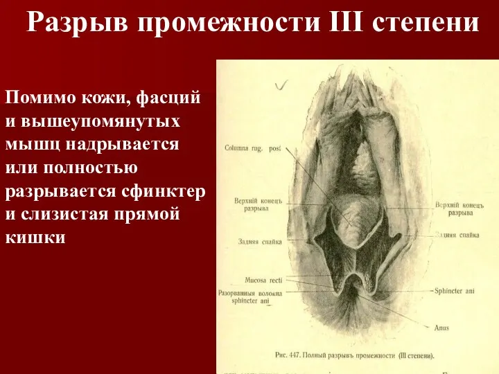 Разрыв промежности III степени Помимо кожи, фасций и вышеупомянутых мышц надрывается