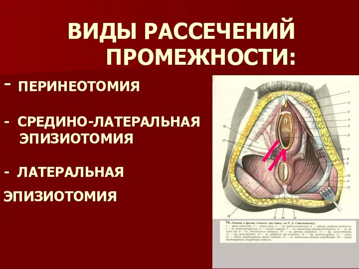 ВИДЫ РАССЕЧЕНИЙ ПРОМЕЖНОСТИ: - ПЕРИНЕОТОМИЯ - СРЕДИНО-ЛАТЕРАЛЬНАЯ ЭПИЗИОТОМИЯ - ЛАТЕРАЛЬНАЯ ЭПИЗИОТОМИЯ