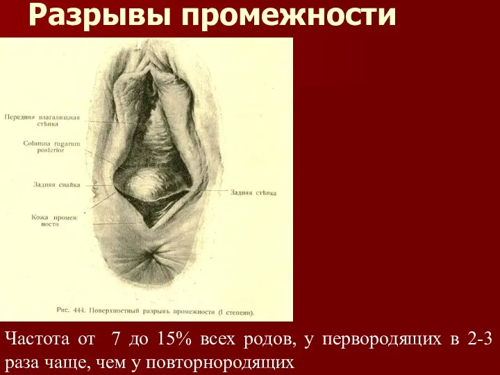 Разрывы промежности Частота от 7 до 15% всех родов, у первородящих