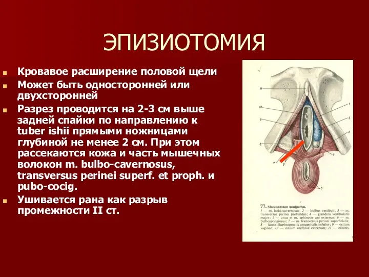 ЭПИЗИОТОМИЯ Кровавое расширение половой щели Может быть односторонней или двухсторонней Разрез