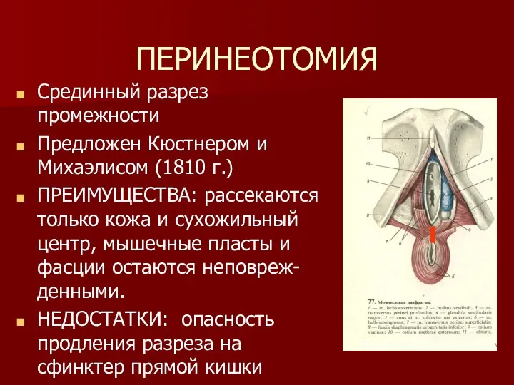 ПЕРИНЕОТОМИЯ Срединный разрез промежности Предложен Кюстнером и Михаэлисом (1810 г.) ПРЕИМУЩЕСТВА: