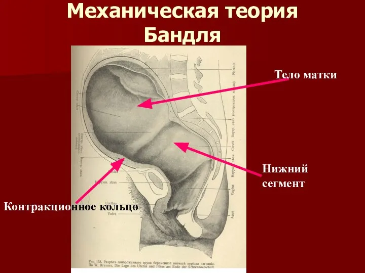Механическая теория Бандля Контракционное кольцо Тело матки Нижний сегмент